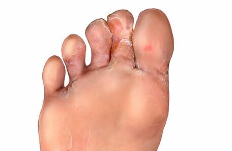 síntomas de fungo do dedo do pé
