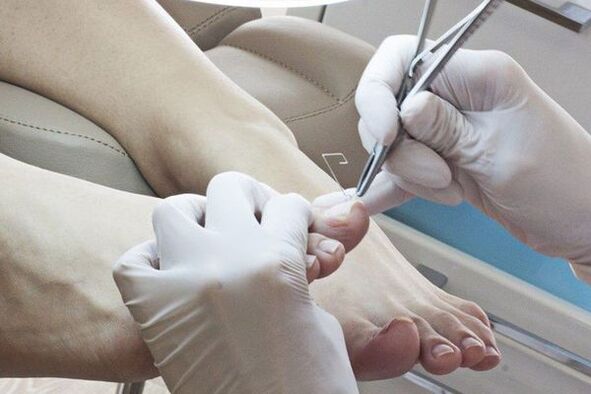 Eliminación mecánica das uñas dos pés afectadas por fungos