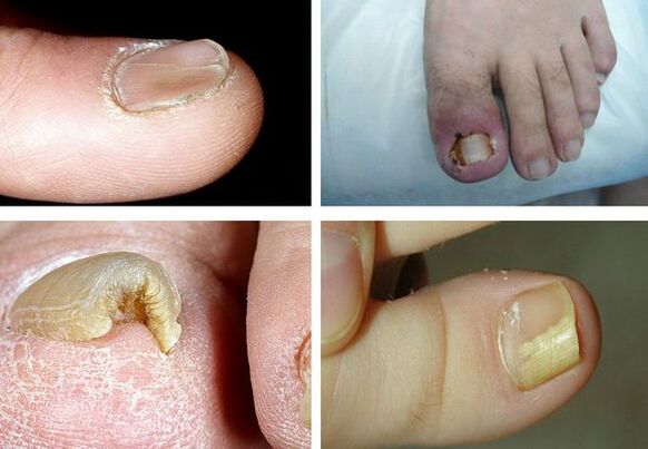 Síntomas de onicomicosis nas pernas