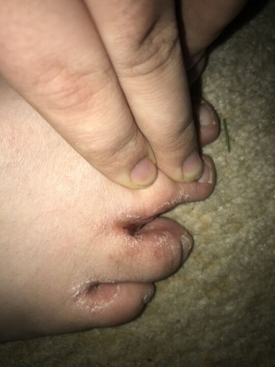 infección por fungos do dedo do pé