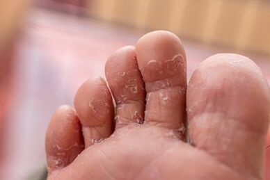 síntomas de infeccións fúngicas dos dedos dos pés